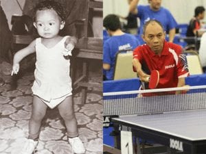 Thalidomide Baby born in the U.S.
