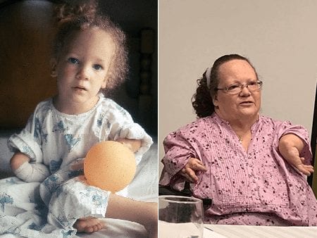 Thalidomide Baby born in the U.S.