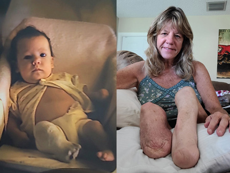 Thalidomide baby born in the U.S. 1962