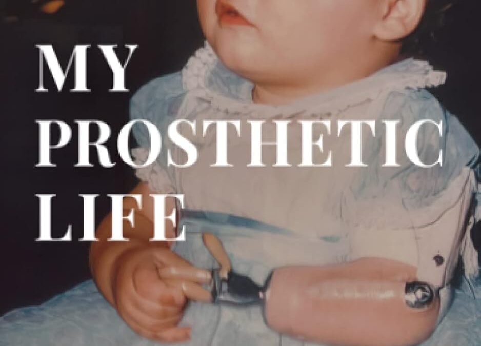 Excerpt from Chapter 1 – My Prosthetic Life